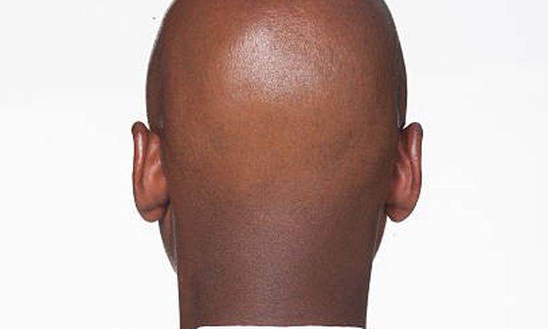 What makes men go bald in their 20s [istockphoto]