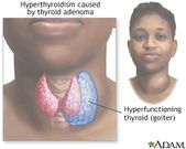 Thyroid disease affects the thyroid gland—a small, butterfly-shaped gland in the neck