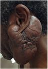 Keloids are prevalent among individuals of African descent