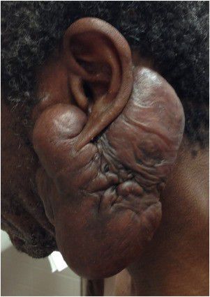 Keloids are prevalent among individuals of African descent