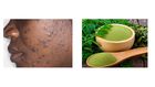 How moringa leaves can clear acne and pimples [datelinehealth/moringaleaves]