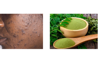 How moringa leaves can clear acne and pimples [datelinehealth/moringaleaves]