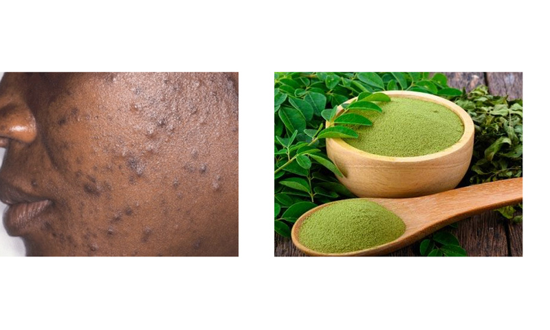 How moringa leaves can clear acne and pimples [datelinehealth/moringaleaves]