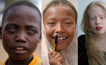 Types of albinos