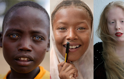 Types of albinos