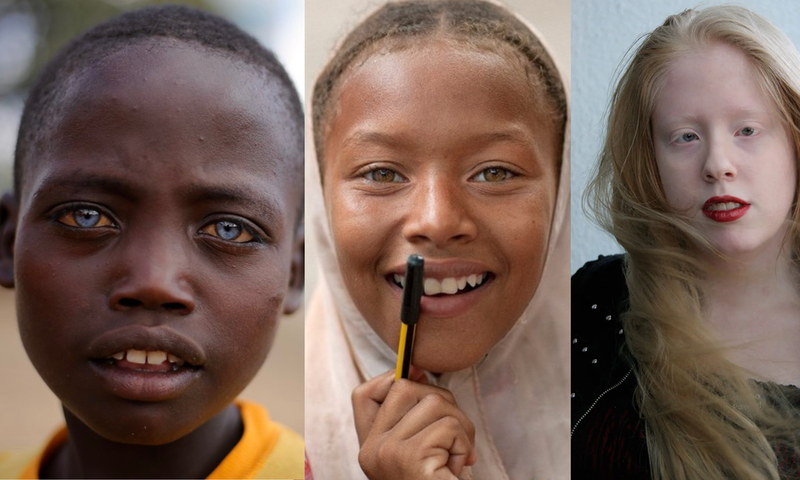 Types of albinos