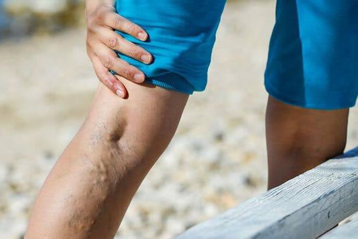 Blood clots [theveininstitute]