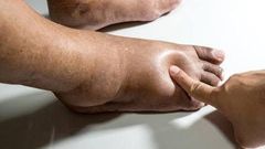 Swollen legs may be as a result of an underlying medical condition [Dr Segal]