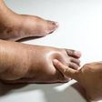 Swollen legs may be as a result of an underlying medical condition [Dr Segal]