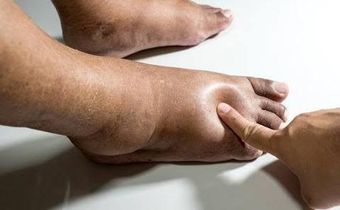 Swollen legs may be as a result of an underlying medical condition [Dr Segal]