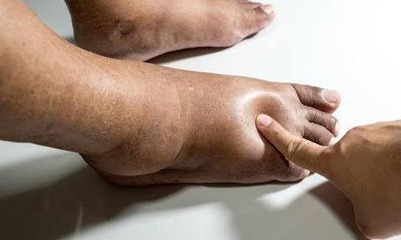 Swollen legs may be as a result of an underlying medical condition [Dr Segal]