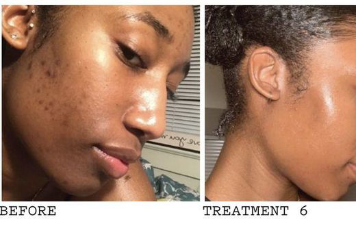 Applying saliva can treat pimples and acne scars [Pinterest]