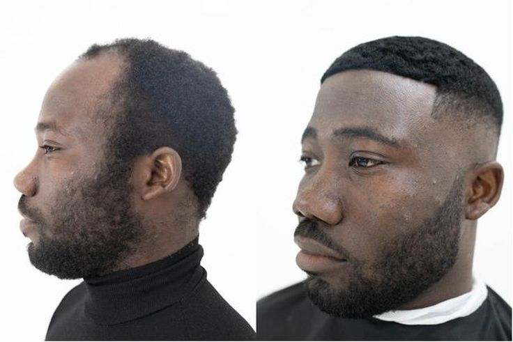 Remedies for men's receding hairline [Blackbeauty]