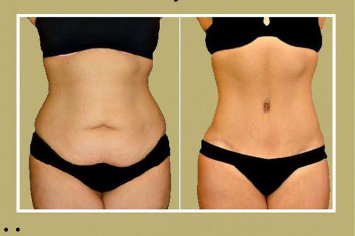 Why does the tummy accumulate fat? [Pinterest]