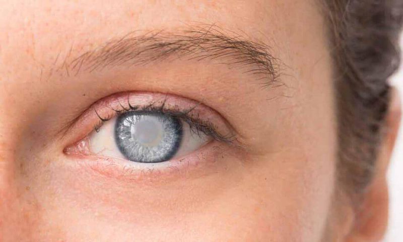 Cataract