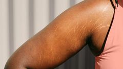 How to get rid of stretch marks [inkillusions]