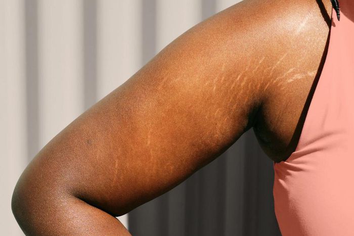 How to get rid of stretch marks [inkillusions]