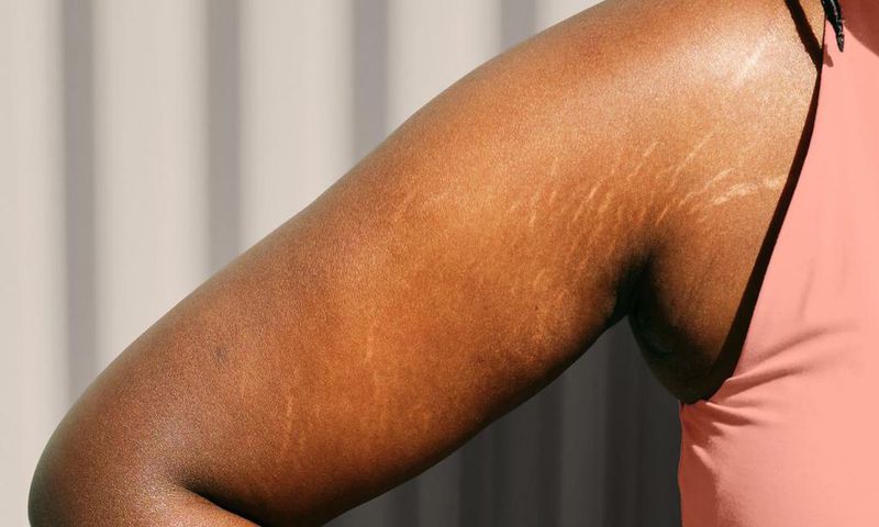 How to get rid of stretch marks [inkillusions]