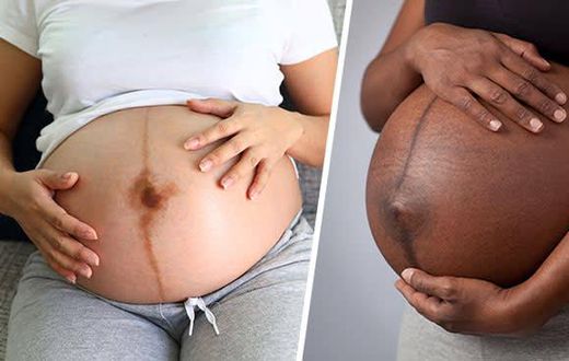 The black line is called linea nigra [The Bump]