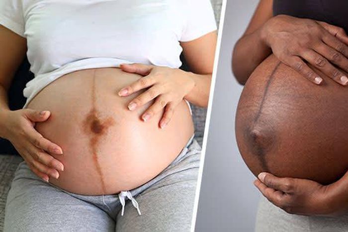 The black line is called linea nigra [The Bump]