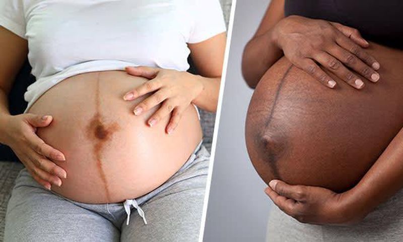 The black line is called linea nigra [The Bump]