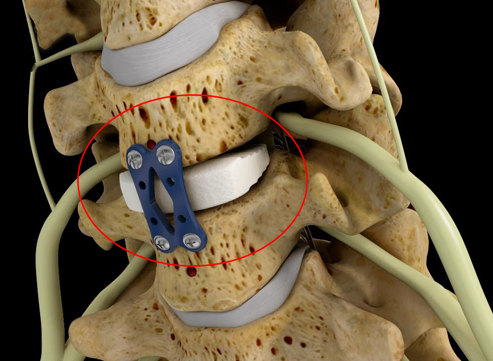Anterior cervical discectomy and fusion