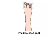 Stretched foot
