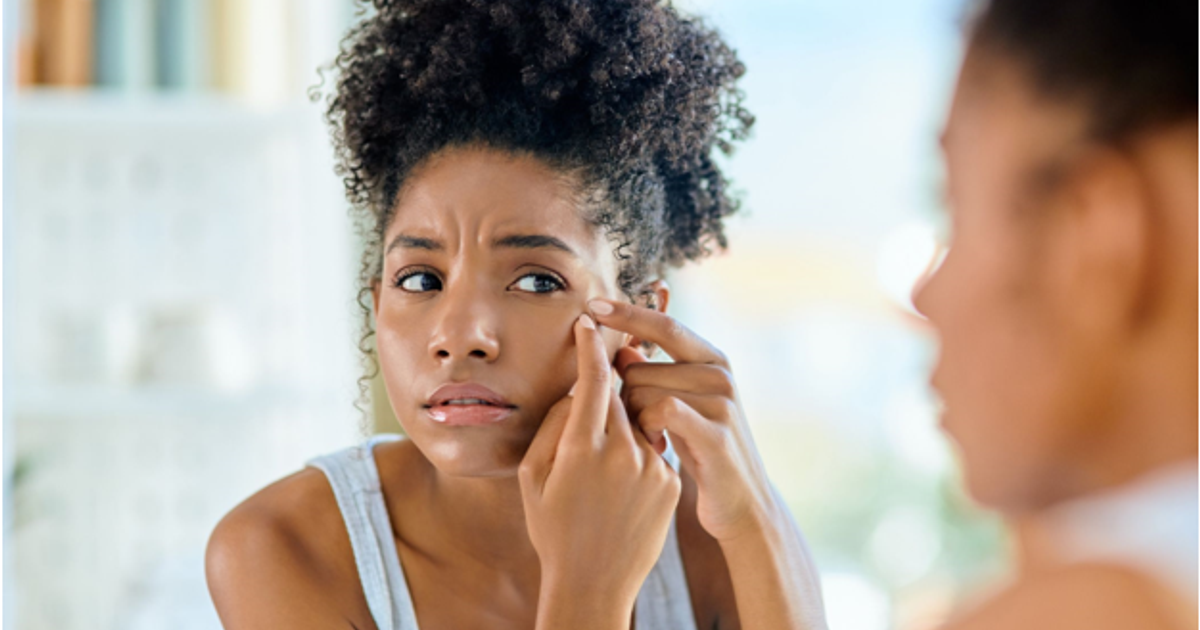 Acne Myths and Misconceptions: What you should and shouldn't believe ...