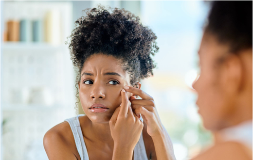 Let's debunk some acne myths [Allure]