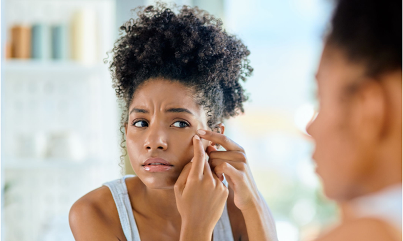 Let's debunk some acne myths [Allure]