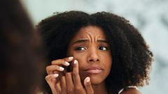 5 healthy home remedies of getting rid of acne scars and pimple marks
