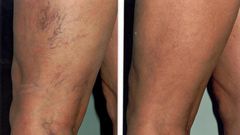 6 simple things spider veins are telling you to do