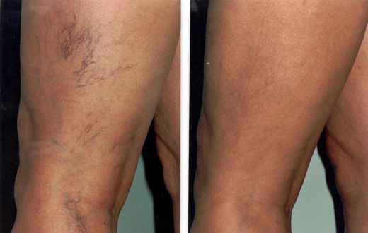 6 simple things spider veins are telling you to do