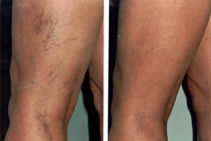 6 simple things spider veins are telling you to do