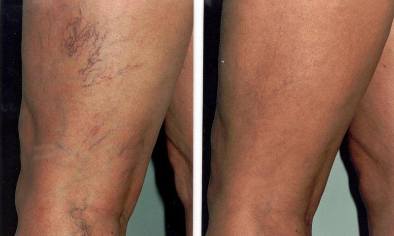 6 simple things spider veins are telling you to do