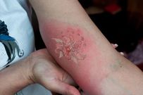 Your body may react to the tatoo [MyMedcom]