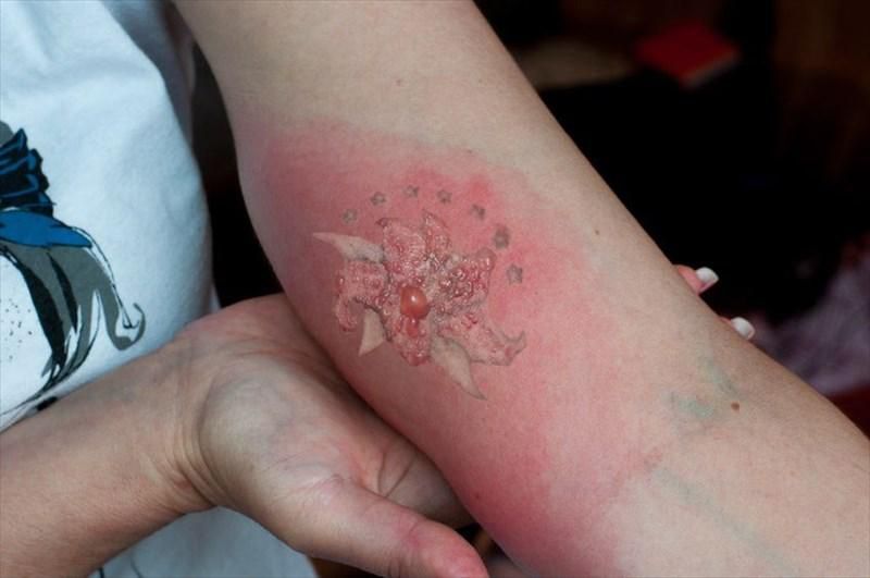 Your body may react to the tatoo [MyMedcom]
