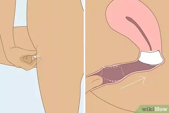 How to use the cervical cap [Wikihow]
