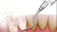 If plaque stays on your teeth for too long, it can harden into tartar