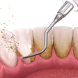 If plaque stays on your teeth for too long, it can harden into tartar