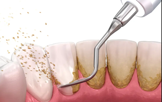 If plaque stays on your teeth for too long, it can harden into tartar