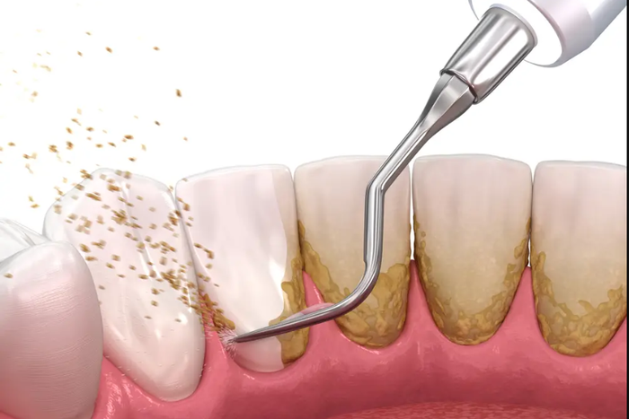 If plaque stays on your teeth for too long, it can harden into tartar