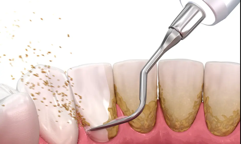 If plaque stays on your teeth for too long, it can harden into tartar