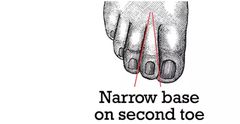 Narrow base on second toe