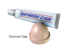 Spermicide and cervical cap [Wikipedia]