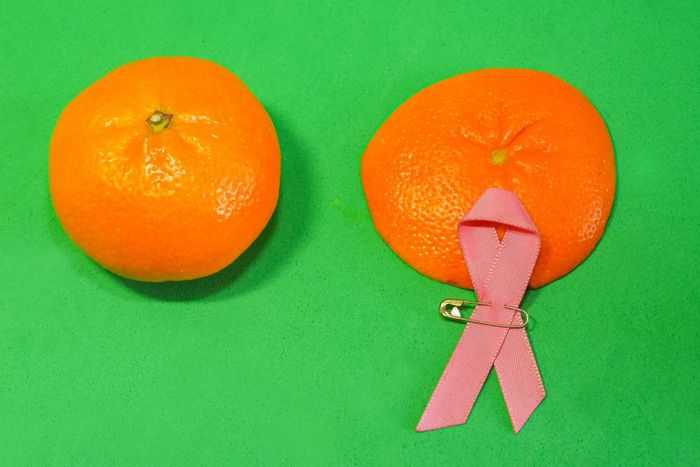 Breast Cancer Women who test positive for certain gene mutations or have a family history of breast cancer may choose to have a prophylactic mastectomy.japatino / Getty Images