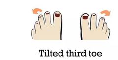 Tilted third toe
