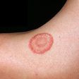 What causes ringworm? [Medicircle]