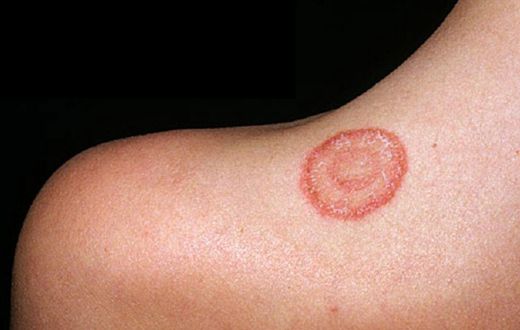 What causes ringworm? [Medicircle]