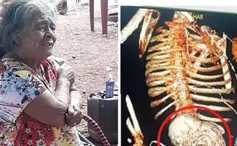 Woman carries dead foetus for 56 years, dies after removal surgery